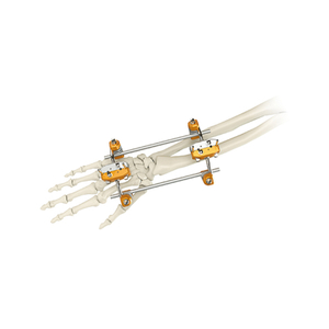 UIna & Radius External Fixator