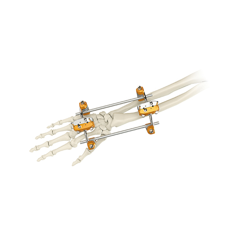 UIna & Radius External Fixator