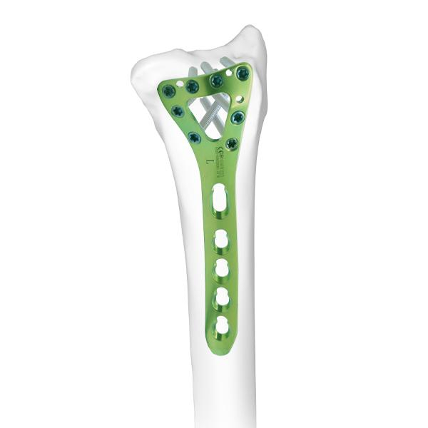 Distal Dorsal Radial Delta Locking Plate