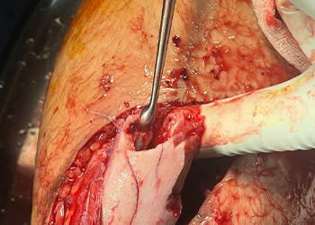 Intraoperative photo 2