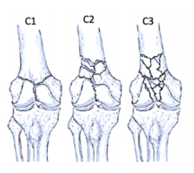 ao-classification-distal-femur-type-c