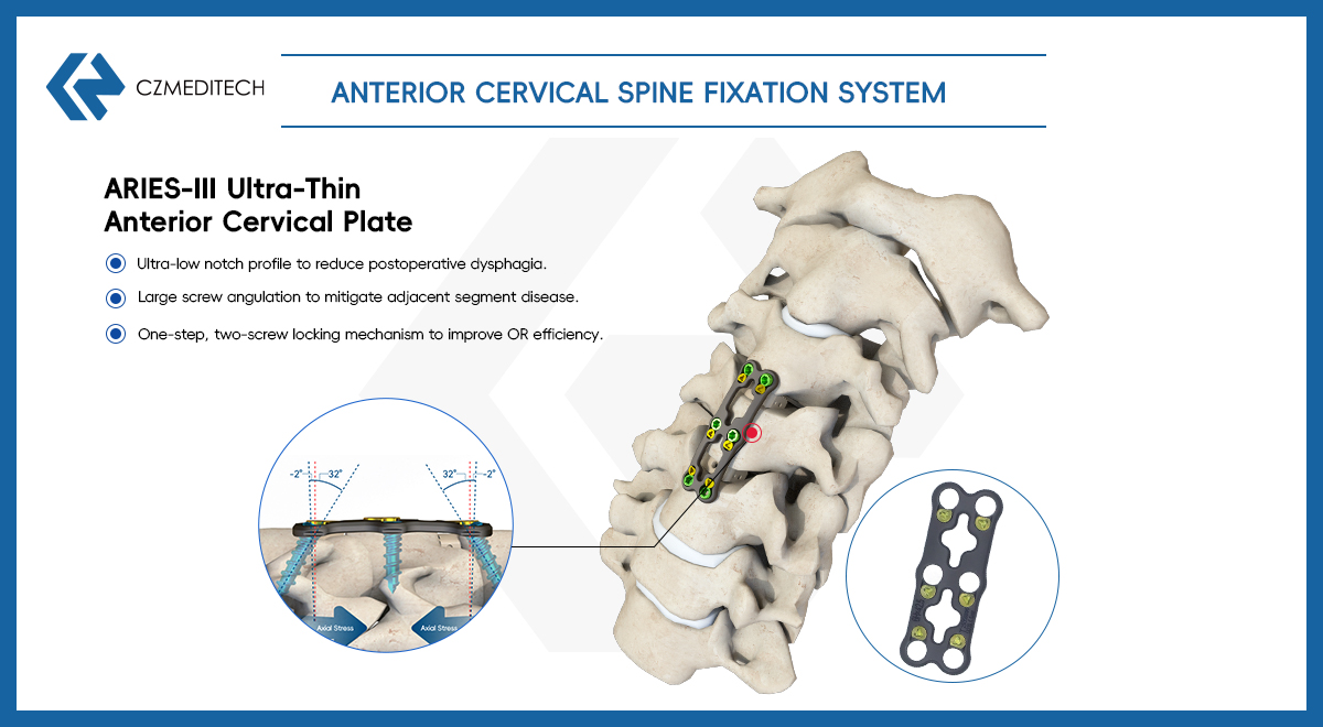 Anterior Cervical Corpectomy and Fusion (ACCF): Comprehensive Surgical Insight and Global Application