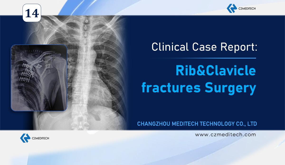 Kalan: Rib & Clavicle kari fixation ni disi kogo sabatili ye Mɛkisiki .