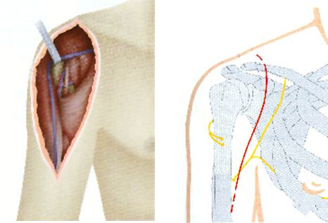 Proximalis humerális törés
