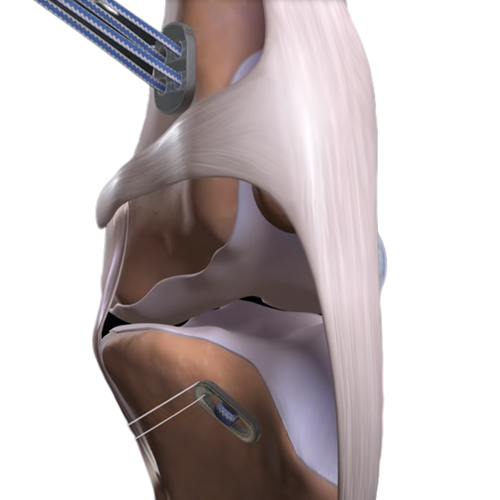 Artificial Ligament System