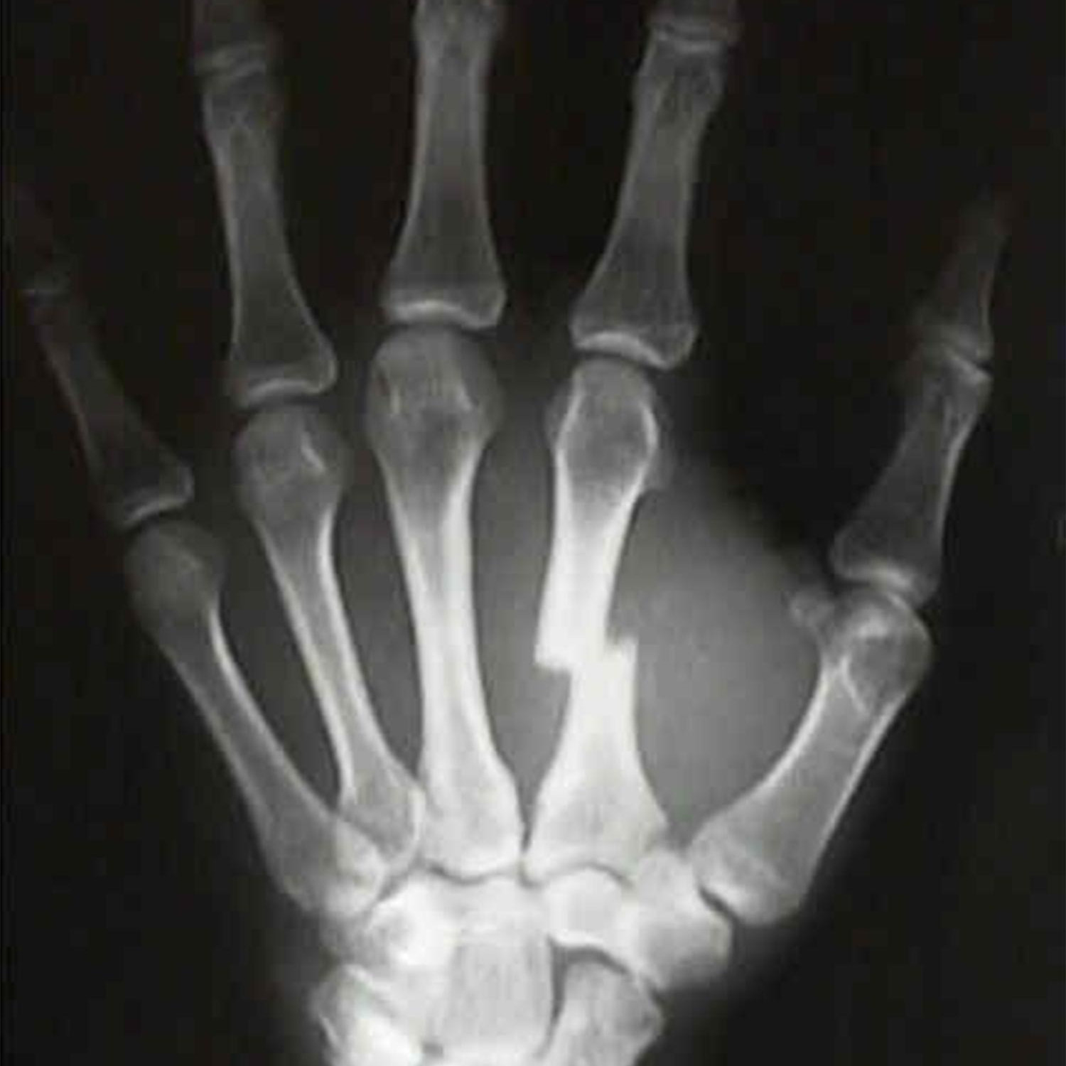 Do you know how to fix a metacarpal fracture?