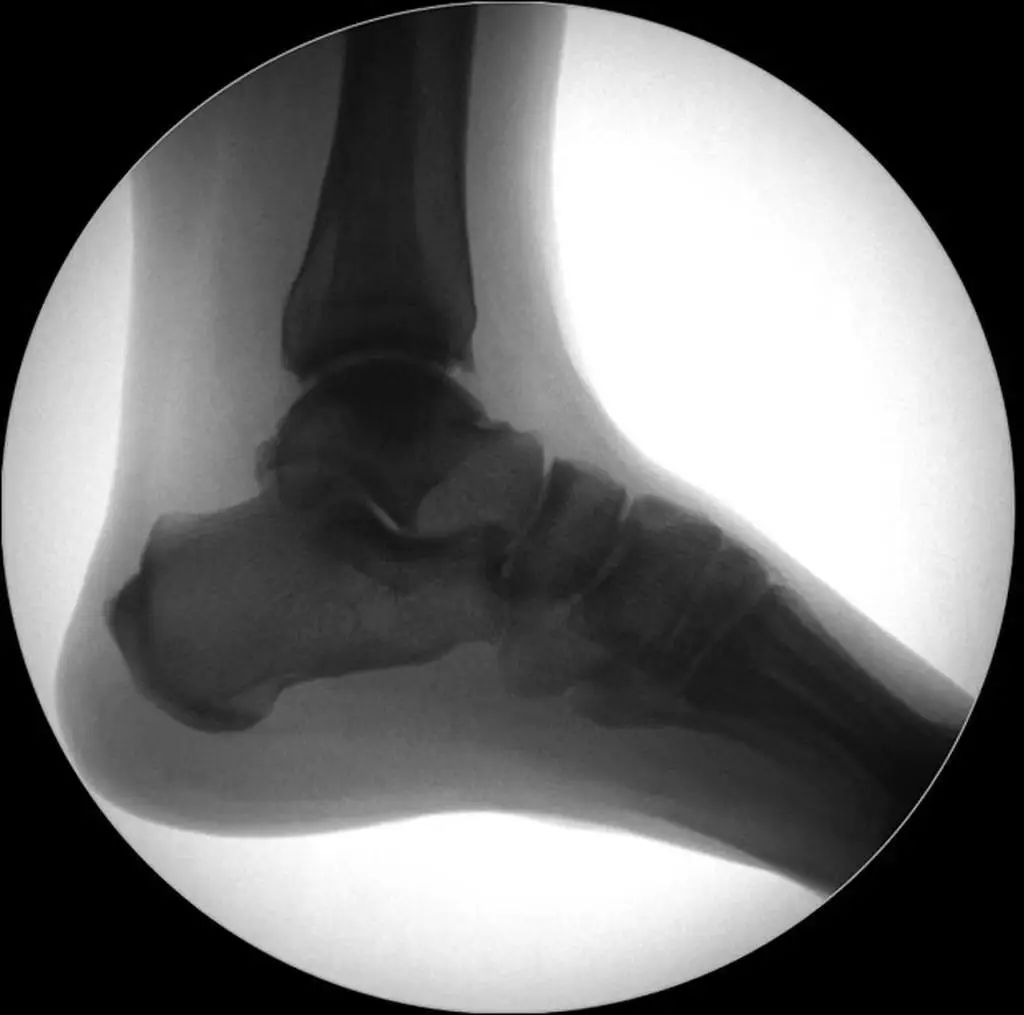 Closed reduction surgery for lower extremity fractures.
