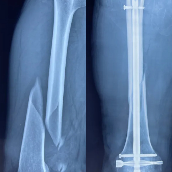 DFN Distal Femur Intramedullary Nail 