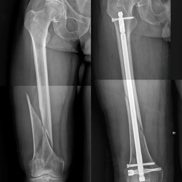 DFN Distal Femur Intramedullary Nail 