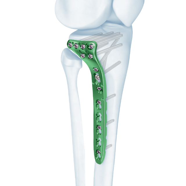 VA Proximal Tibia Locking Plate