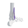 Distal Lateral Fibular Locking Plate
