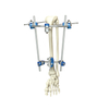 Proximal Tibia External Fixator