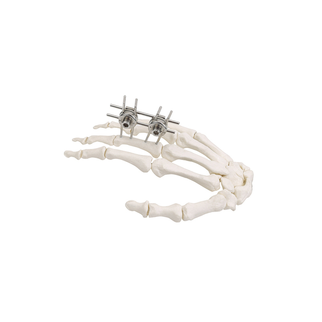 Mini-External Fixator(Finger & Palm)