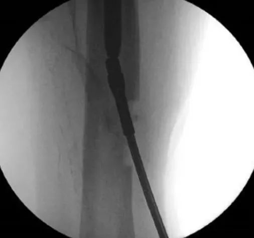 remove a broken solid intramedullary nail