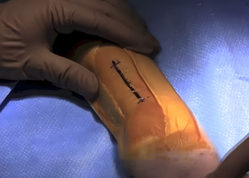 Distal Radius Fracture Surgery in Mexico &mdash; Using CZMEDITECH VA Locking Plate System2