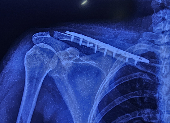 postoperative-clavicle-locking-plate-fixation-czmeditech