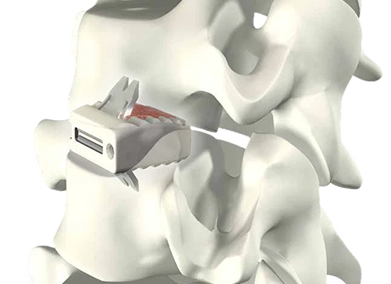 CZMEDITECH Uni-C Standalone Cervical Cage sterilized implant for cervical fusion 1