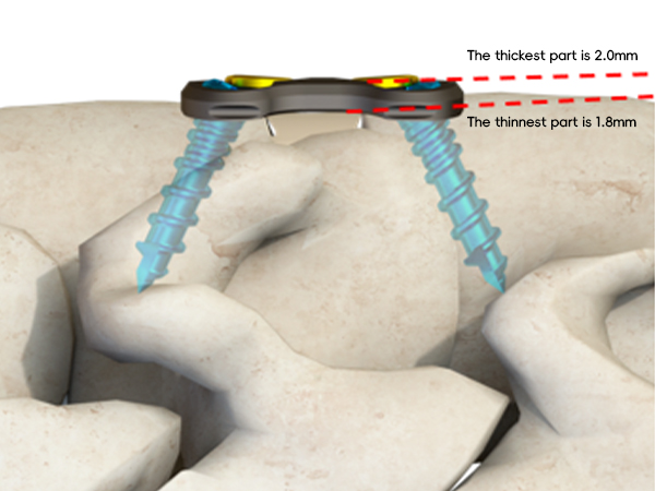 Anterior Cervical Corpectomy and Fusion (ACCF)-czmeditech5