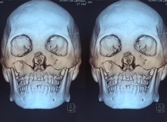 preoperative-imaging-lefort-fracture-ghana-czmeditech