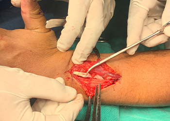 intraoperative-tendon-ekspozim-tenorrafi-peru-czmeditech