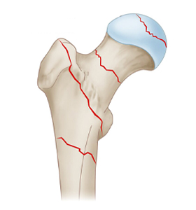 subtrochanteric-and-intertrochanteric-fracture-intramedullary-fiksasi kuku
