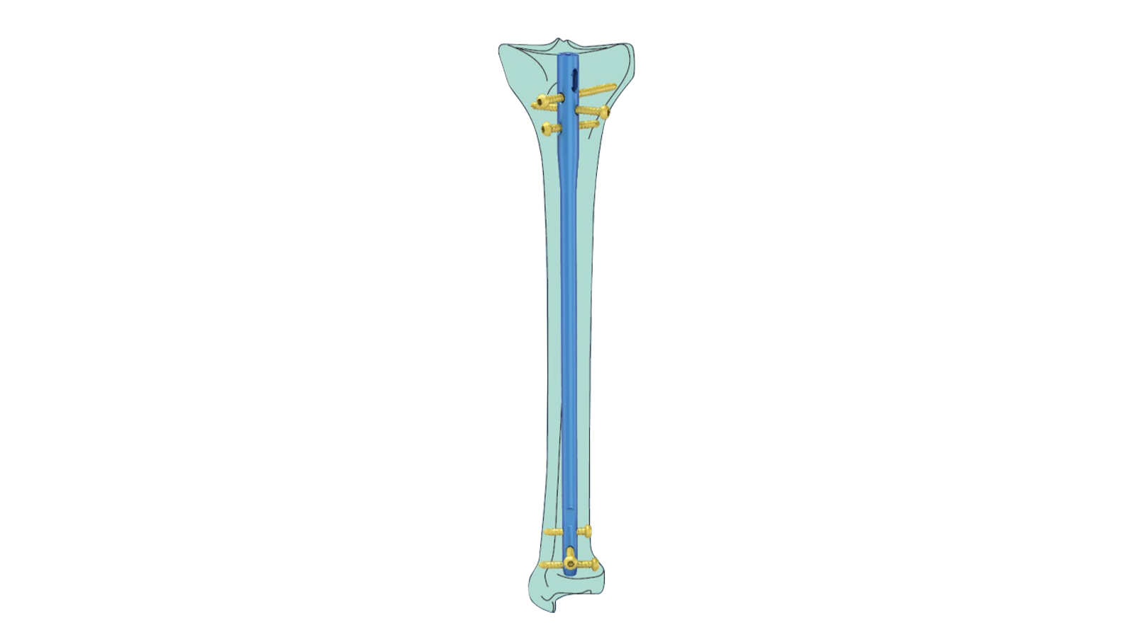SURA™ Suprapatellar Tibial Intramedullary Nail