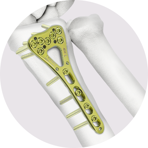 Distal radius plate placement illustration