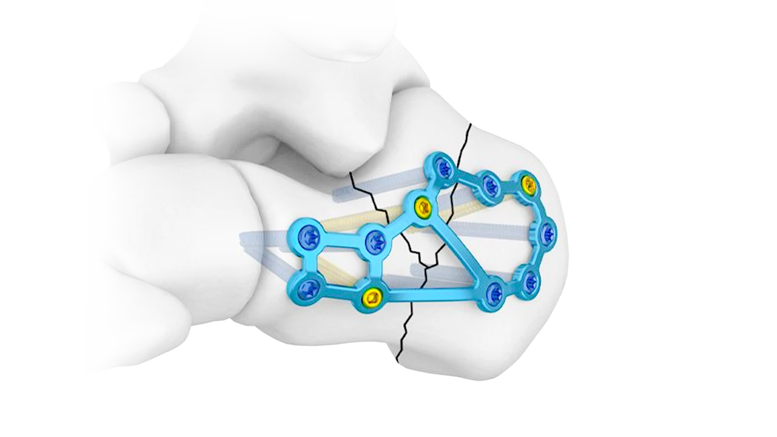 Foot and Ankle locking plate system