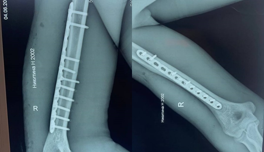 Postoperative right humeral locking plate X-ray