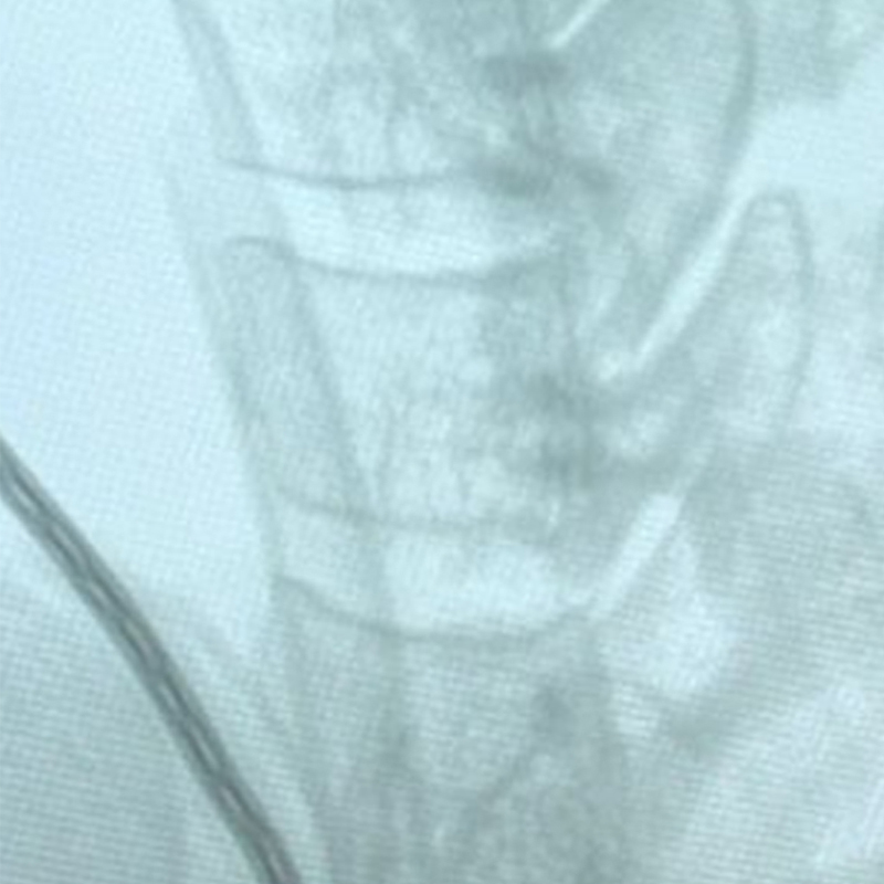 Antaŭoperacia laterala cervika spino-radiografio