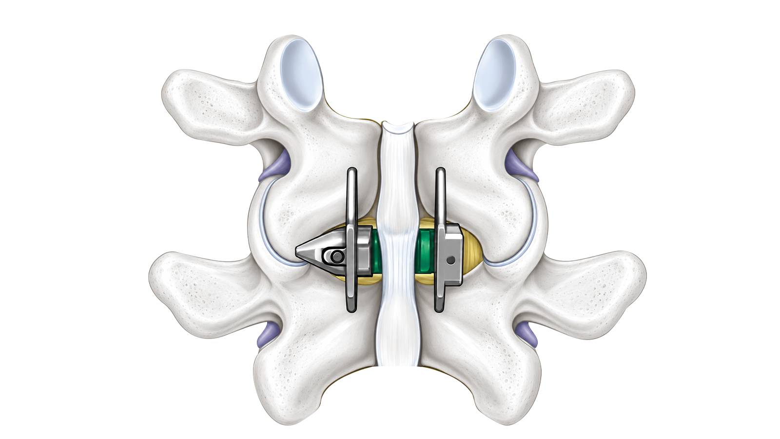 SPINA-S™ Interspinous Spacer System