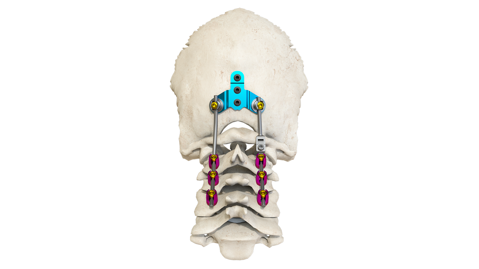 TAURUS™ Occipito-Cervico-Thoracic Fixation System