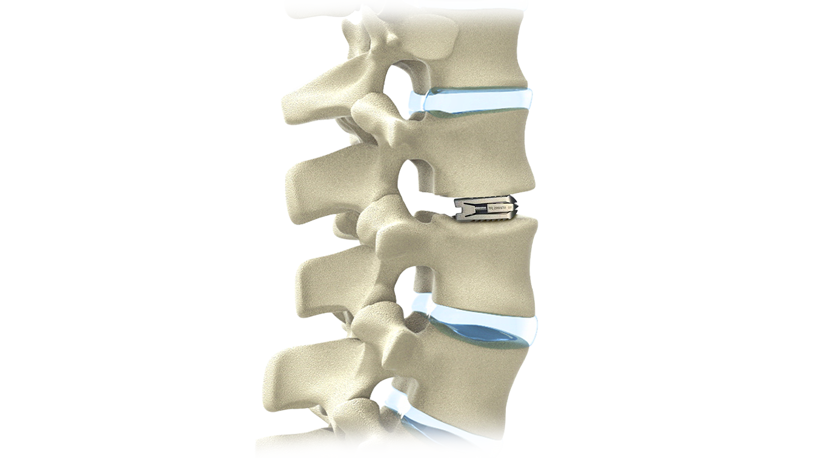 FUSA-XP™ Expandable Titanium Posterior Lumbar Interbody System