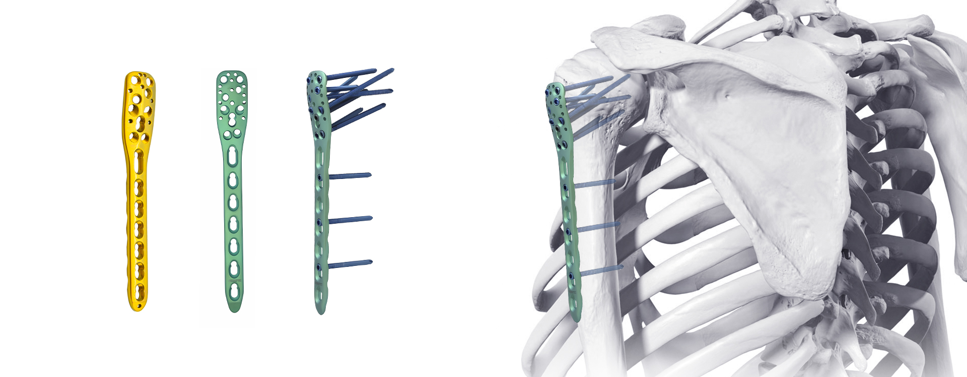proximal humerus locking plaat fixation sjirurgyske application.jpg