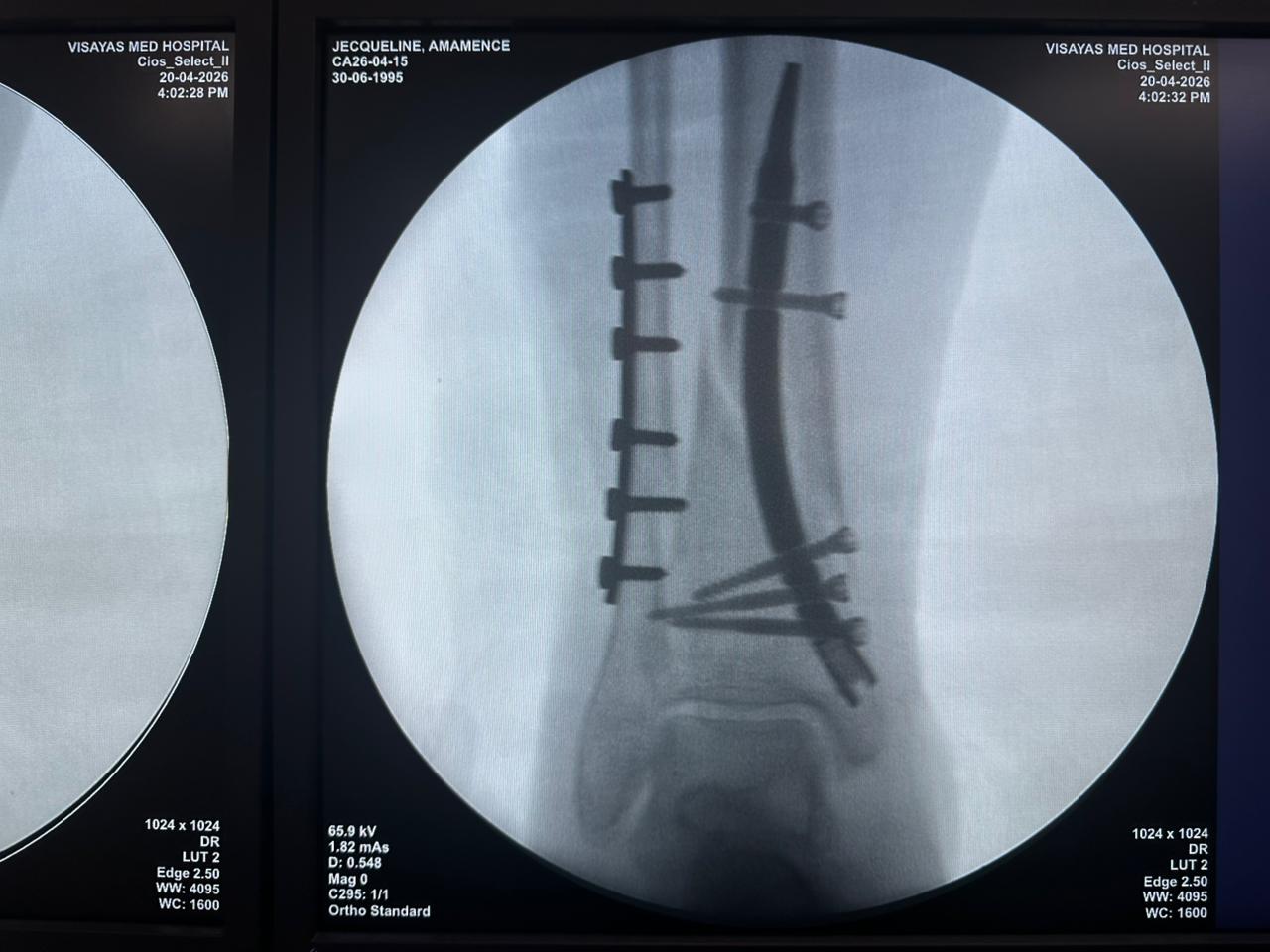 fluoroscopia-intraoperatoria-chiodo-tibia-distale-CZMEDITECH (4)