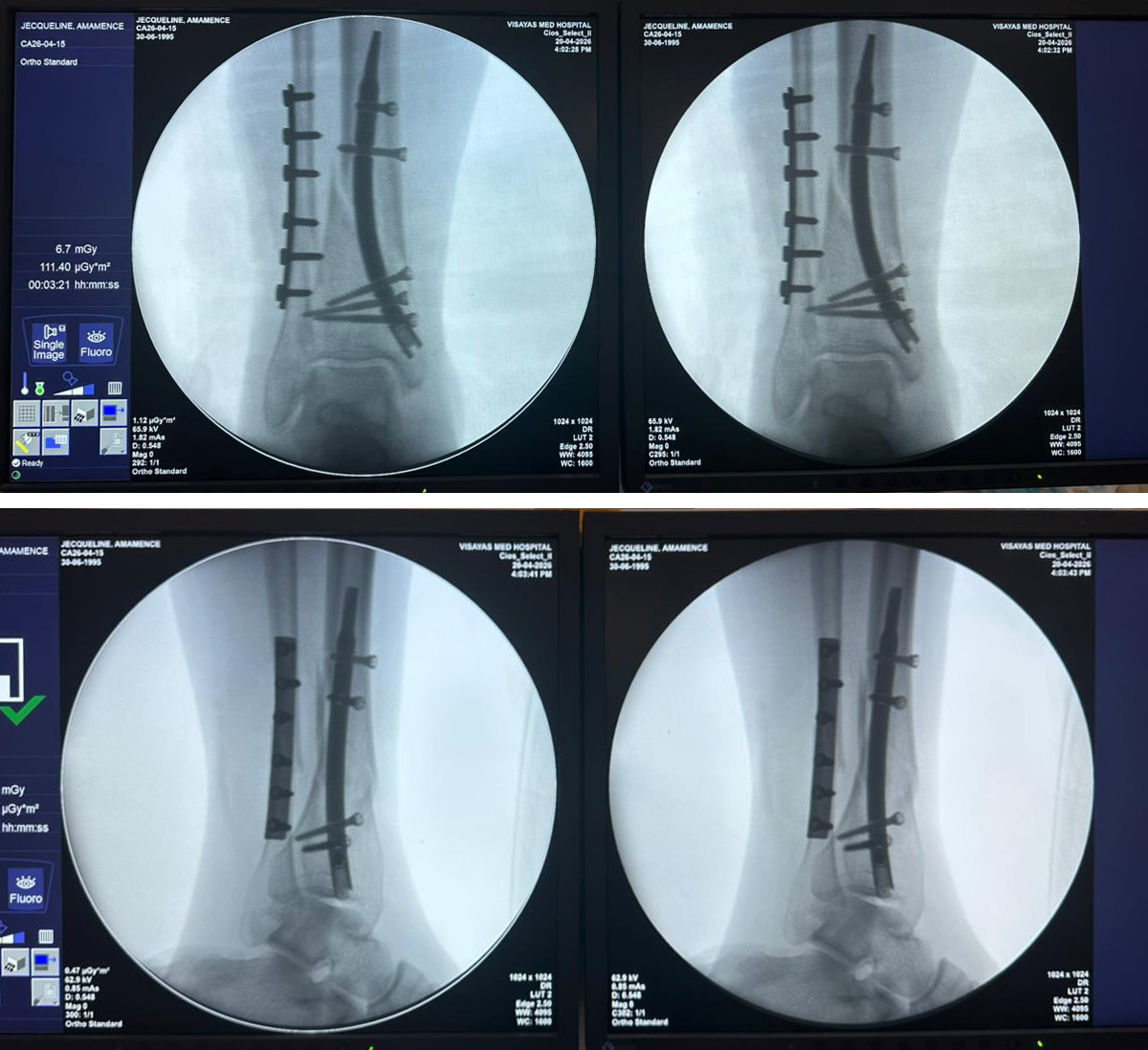 Distaalinen s&auml;&auml;riluun kynsi - 31 vuotta