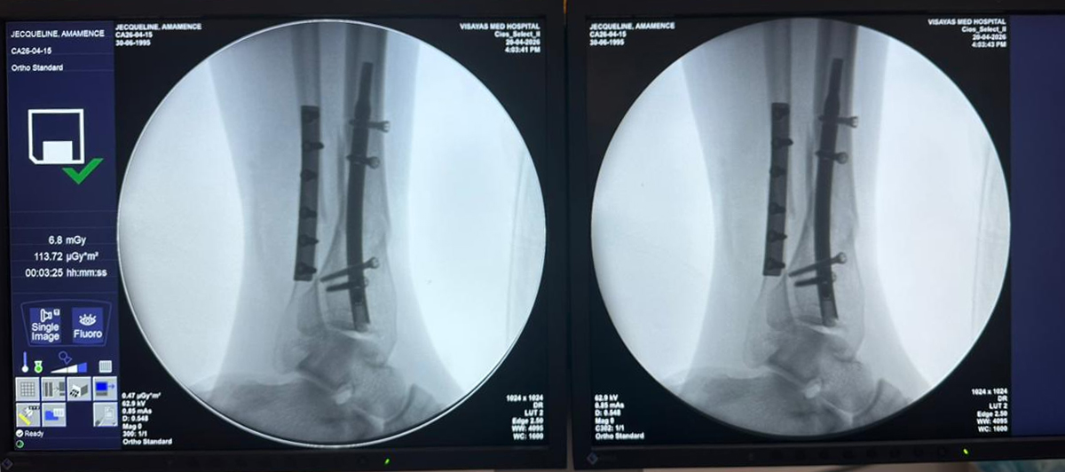 ເລັບ Tibial ປາຍ- 31 ປີ