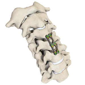 V&AElig;DDER Anterior cervikal plade-III