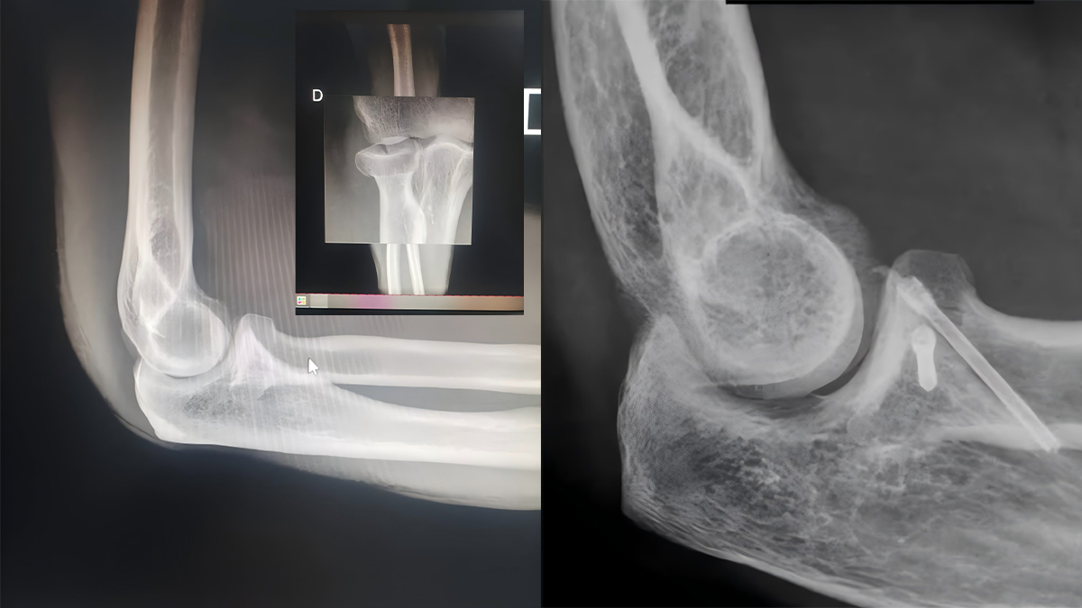 Elbow X-ray views showing headless screw fixation