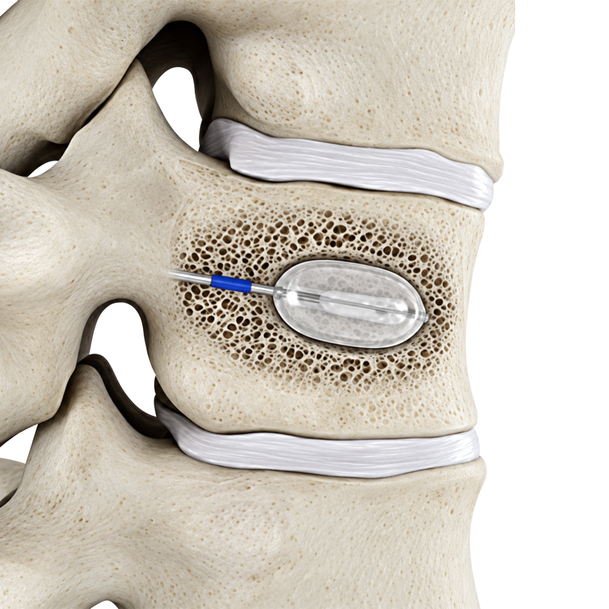 CZMEDITECH kyphoplasty balloon system