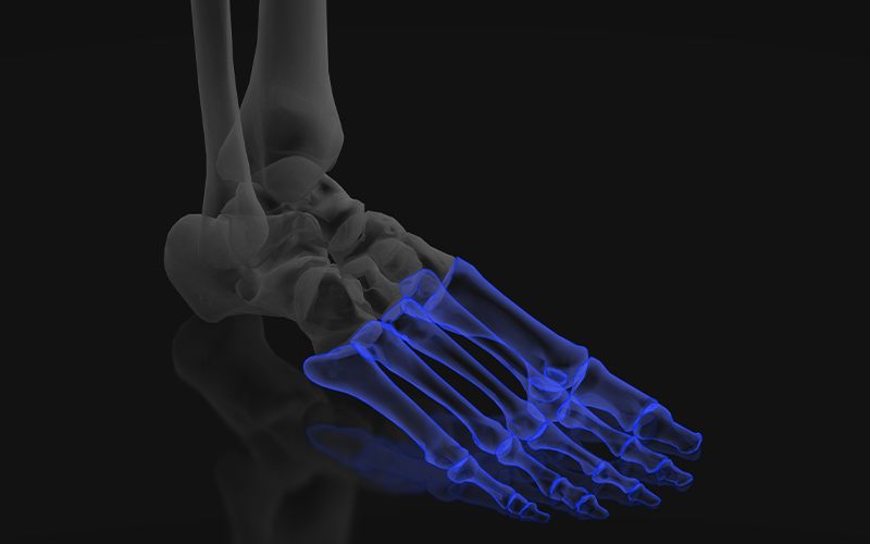 Forefoot bones highlighted in blue on a foot anatomy illustration
