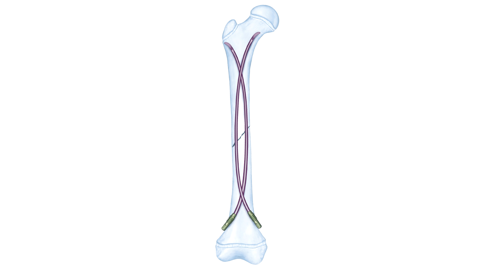 Pediatric intramedullary nail system