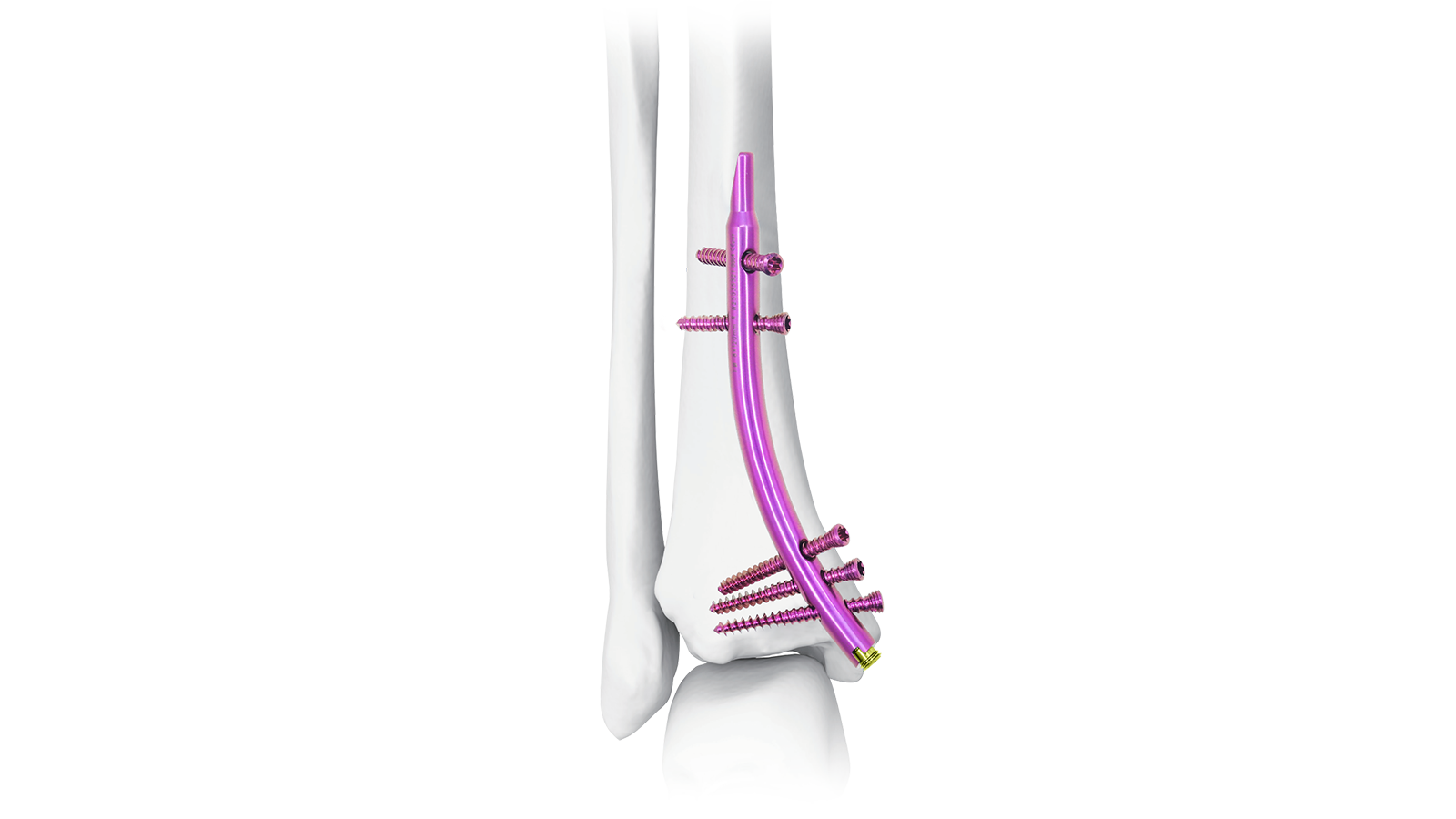 Tibia intramedullary nail system