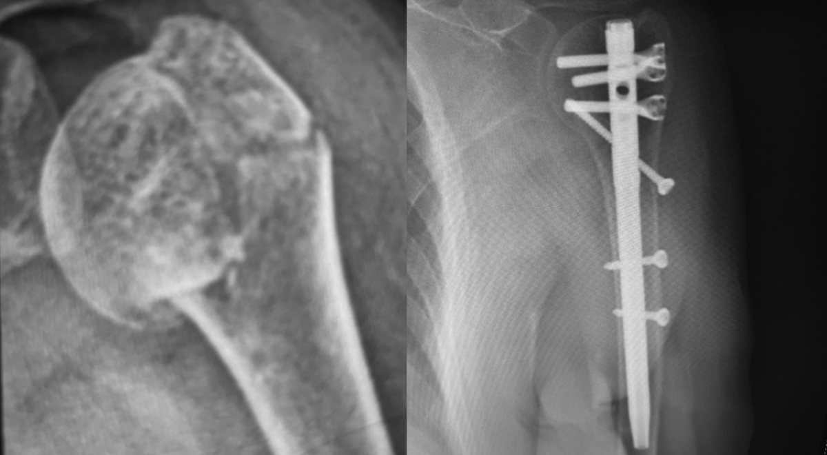 Humeral Head Fracture Treated with Multi-lock Humeral Intramedullary Nail