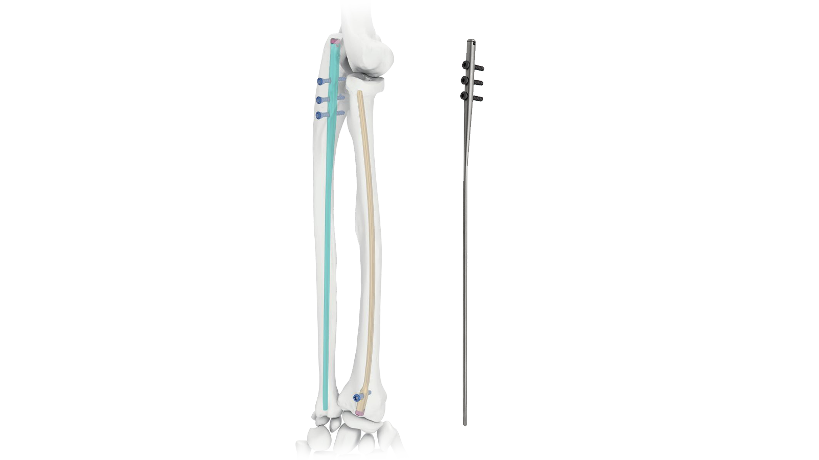 ULIX™ Ulna Intramedullary Nail