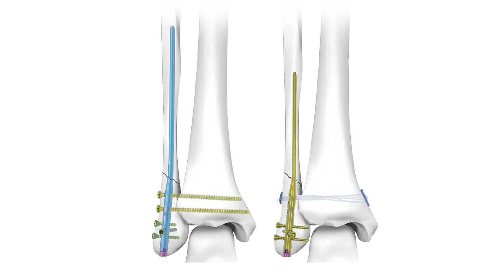 Fibula intramedullary nail system