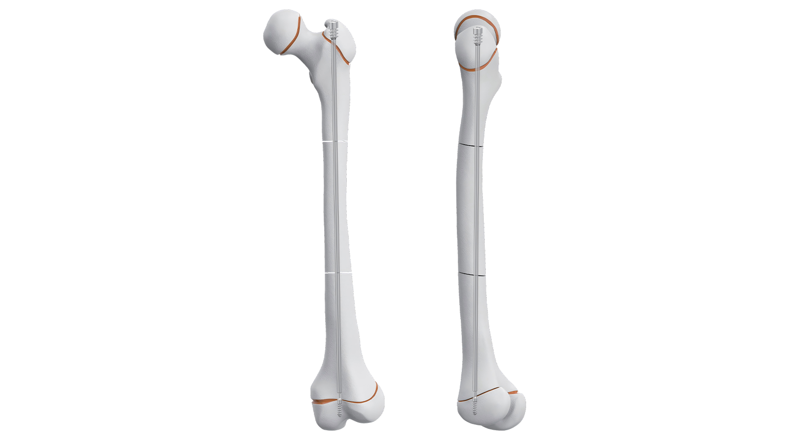 PIVO™ Pediatric Slide Intramedullary Nail
