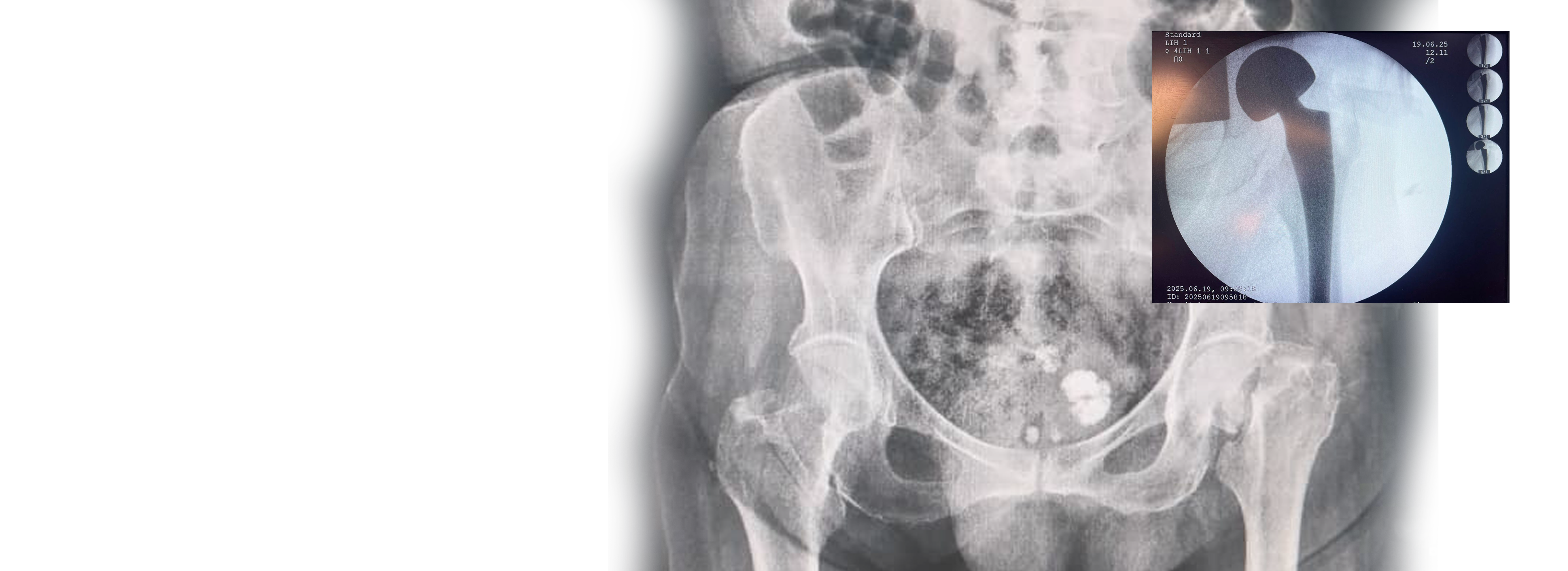 Left hip fracture treated with a modular bipolar prosthesis in Venezuela