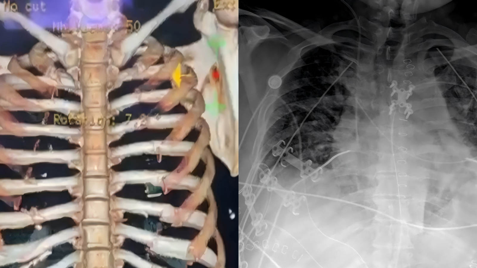 Rib & Clavicle Fracture Fixation with Chest Wall Stabilization in Mexico