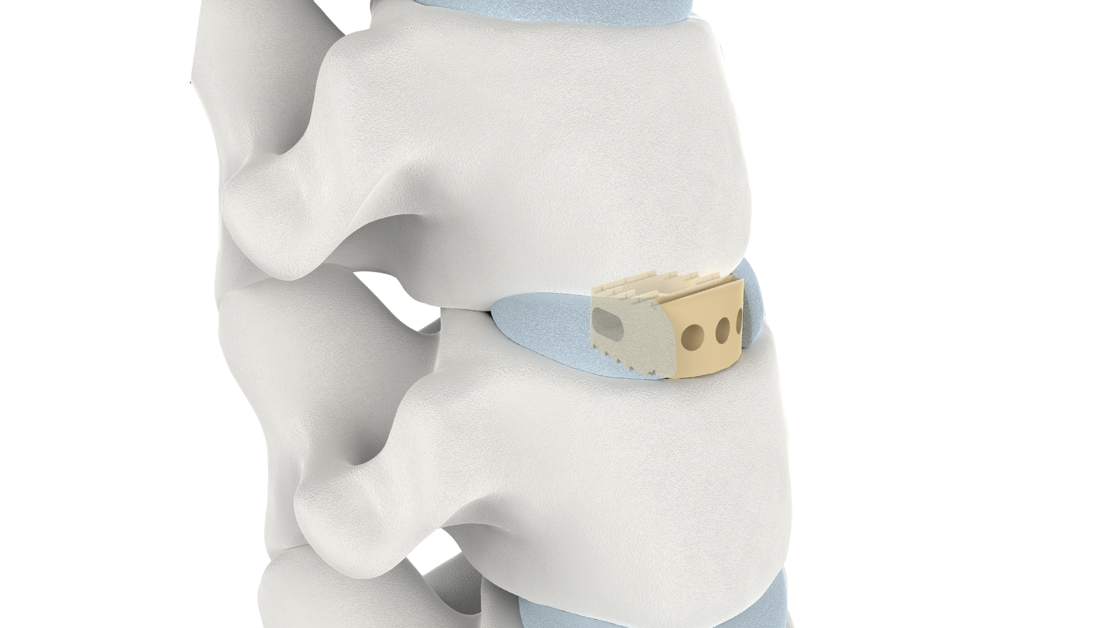 FUSA-II™ Cervical PEEK Interbody System